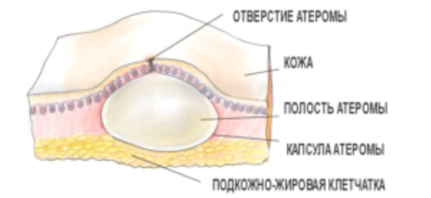 Что находится возле яичка и Дискомфорт справа
