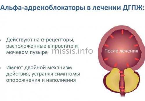 Простатиты у мужчин признаки чем лечить лекарства