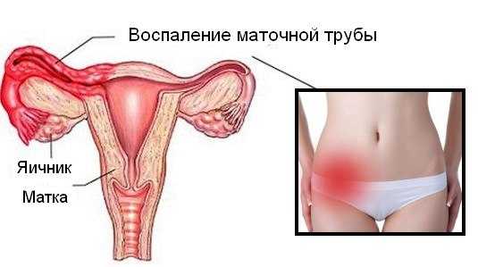 Тянущая боль внизу живота у женщин справа ближе к паху отдающая в ногу