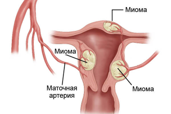 Пролапс матки — причины и симптомы опущения матки