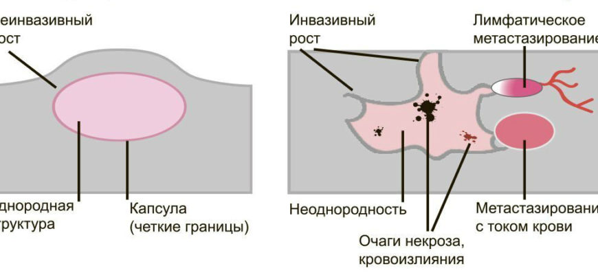 Чем отличается доброкачественная опухоль от злокачественной