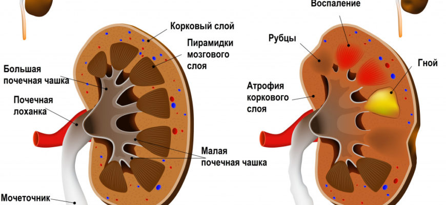 Острый пиелонефрит