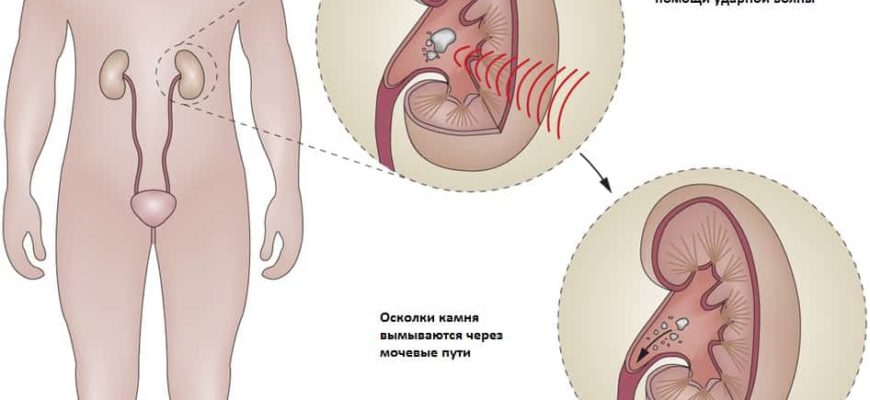 Дробление камней в почках, мочеточнике и мочевом пузыре (литотрипсия)