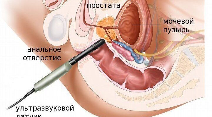 Повышение ПСА и биопсия предстательной железы