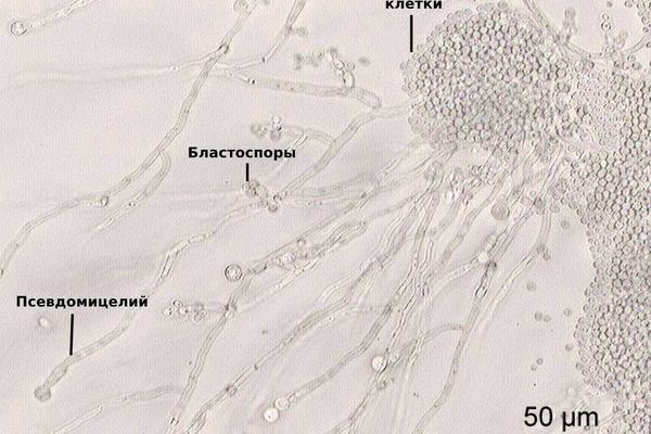 Грибок в моче причины у женщин и лечение