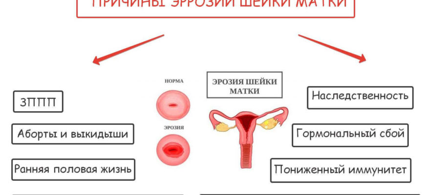 Эндоцервикоз что это такое в гинекологии расшифровка