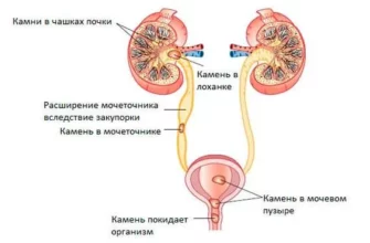 Как вывести песок с почек быстро и эффективно форум