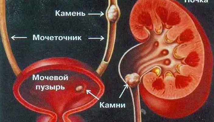 Как выходит камень из мочеточника у женщин симптомы