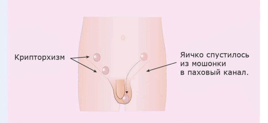 Правое яичко поднимается вверх и тянет