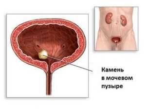Как дробят камни в мочеточнике ультразвуком у мужчин