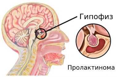 Пролактин повышен у мужчины причины и последствия