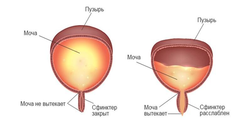 Нарушения опорожнения мочевого пузыря – диагностика и лечение. Часть 2