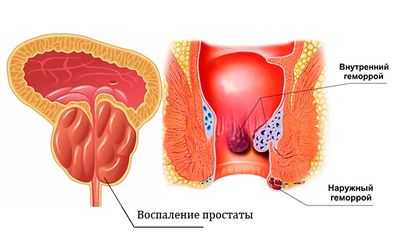 Может ли геморрой влиять на потенцию мужчины